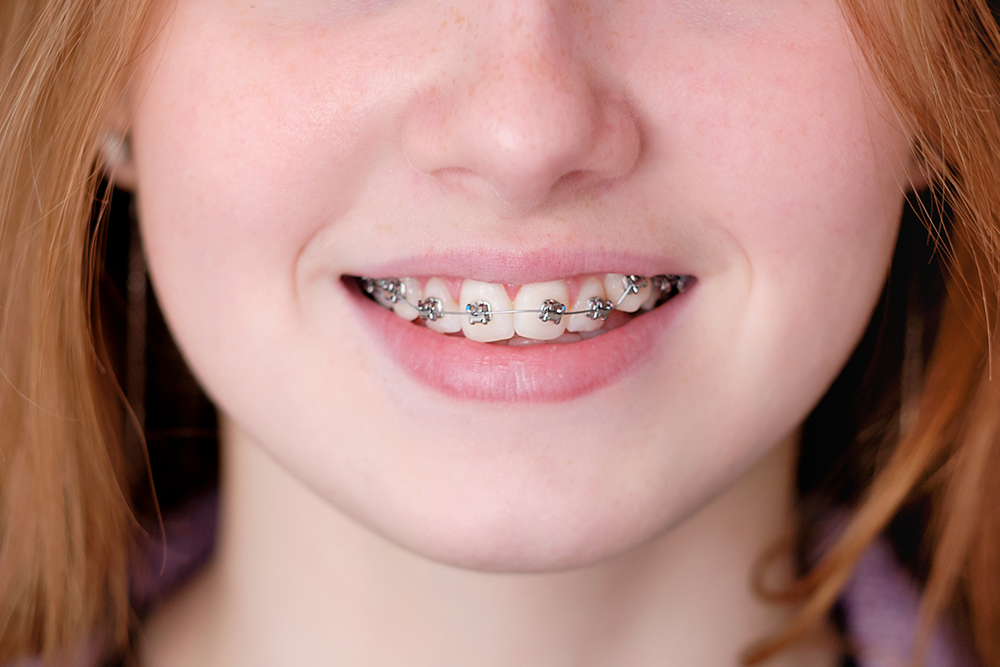 What Are The Stages Of Braces Treatment